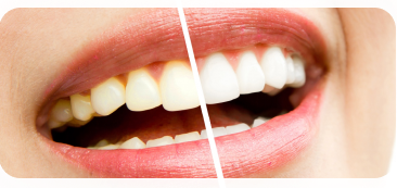 Teeth whitening Dental Office in Naperville, IL